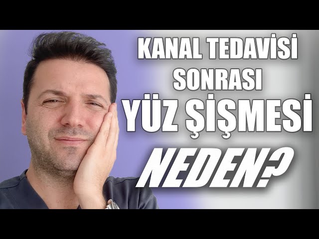 Kanal Tedavisi Sonrasında Neden Yüz Şişer? Kanal Tedavisi Sonrasında Ağrı Olur mu? Nasıl Yapılır? class=