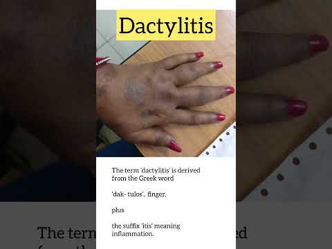 वीडियो: क्या डैक्टिलाइटिस दूर होता है?