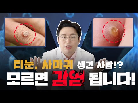 (ENG)이거 모르면 진짜 감염될 수 있습니다..｜티눈 사마귀 없애는 법｜피부 트래블러 - 피부과 전문의 노성민