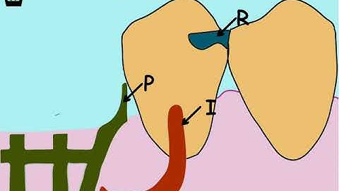 RPI System, removable partial denture