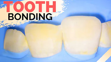 Can you brush your teeth after dental bonding?