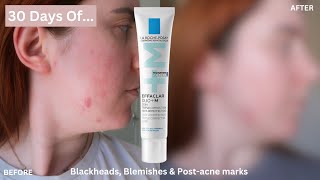 30 DAYS OF La RochePosay Effaclar Duo for Blemishes, Blackheads & PostAcne Marks |One Month Review