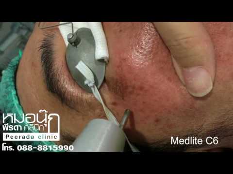 Medlite C6 เลเซอร์รักษาฝ้า กระ รอยดำสิว By พีรดา คลินิก