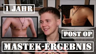 Mastek-Ergebnis FTM | Dr. Schwarz | Reinbek St. Adolf-Stift | Mastektomie/top surgery 1 Jahr post OP