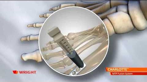 CHARLOTTE™ MTP Fusion System Animation