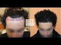 Hasil Transplantasi Rambut FUE - 3456 Cangkok (0 hari hingga 10 Bulan Pasca Operasi) | Klinik BHR