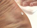 Plantar wart