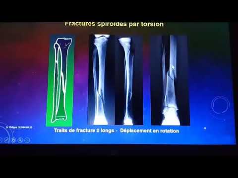 Vidéo: Fractures Osseuses - Types, Traitement, Rééducation