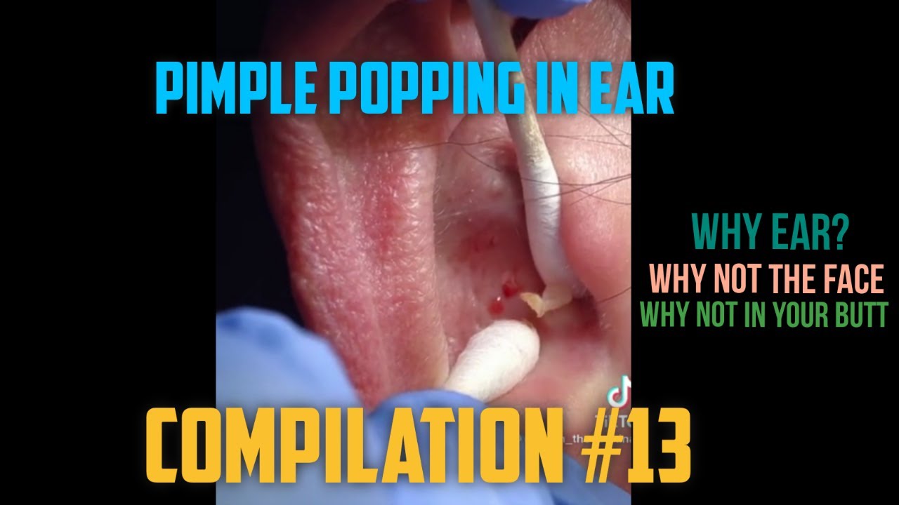 PIMPLE POPPING IN EAR PIMPLE POPPING THIS WEEK COMPILATION 13