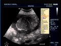 Ultrassom - Silas Jr. 36 Semanas