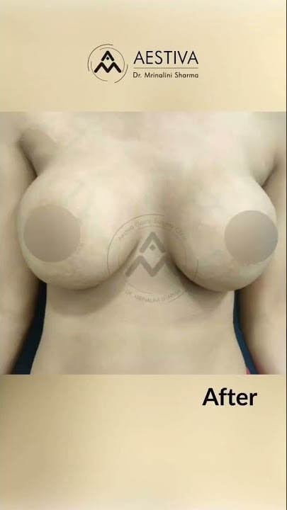 Enhance the size and shape of breast with Breast Implant Surgery #breast #breastimplant #shorts