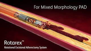Rotarex™ Rotational Excisional Atherectomy System MoA video