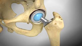 Total hip replacement