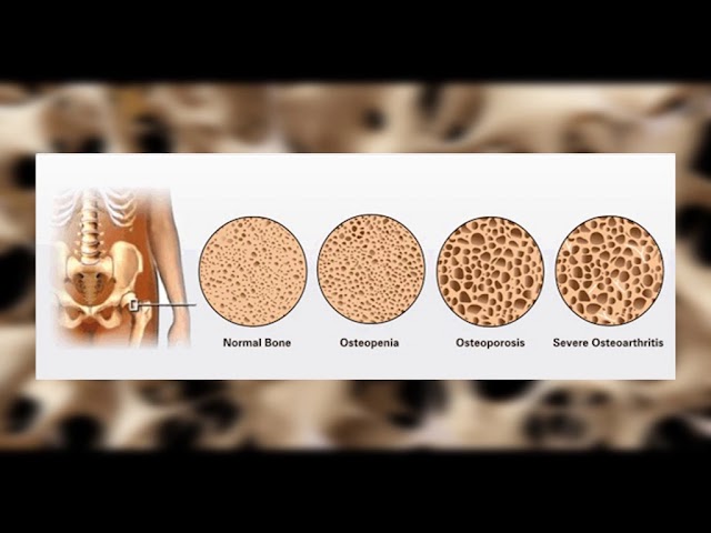 TV Pančevo - Osteoporoza vodi u invalidnost