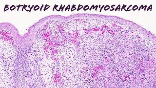 Botryoid embryonal rhabdomyosarcoma: Basic soft tissue pathology (