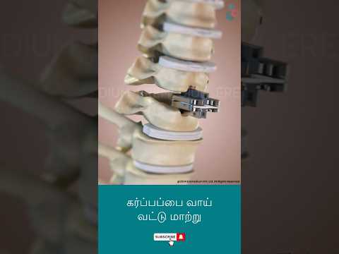 கர்ப்பப்பை வாய் வட்டு மாற்று ↪ 3D Medical Animation #Shorts #DiscReplacement #Surgery