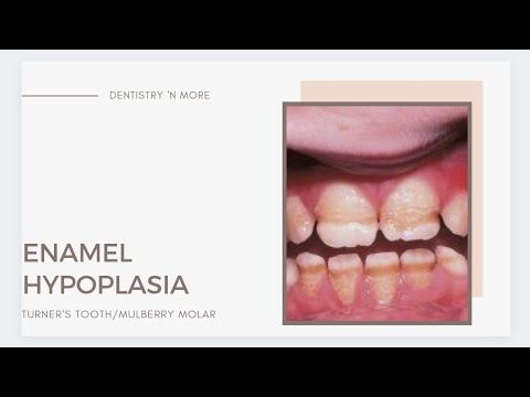 Video: Dental Hypoplasia: Treatment, Causes, Photos, Forms