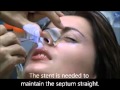 Removing a Nasal Stent on the 7th Day After Rhinoplasty