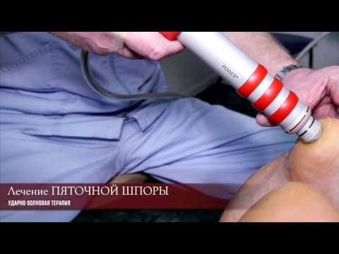 Лечение пяточной шпоры методом ударно-волновой терапии