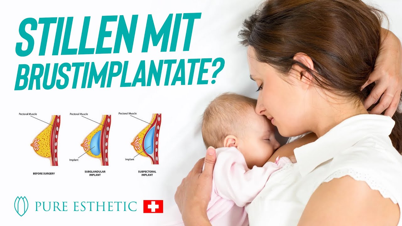 Kann man mit Brustimplantaten stillen? - YouTube