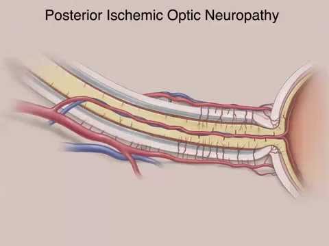 Video: Ischemic Neuropathy Of The Optic Nerve