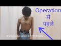 Brachial plexus surgery by dr ps bhandari