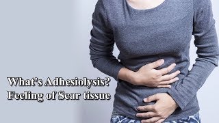 Laparoscopic Adhesiolysis \u0026 What does scar tissue feel like?- Dr. Sireesha Reddy