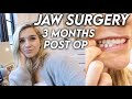 Jaw Surgery... 3 Months Later!