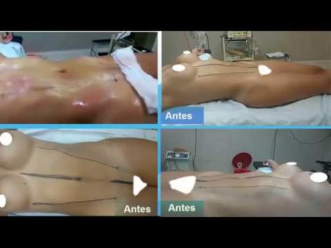 Marcacion abdominal antes y despues mujeres