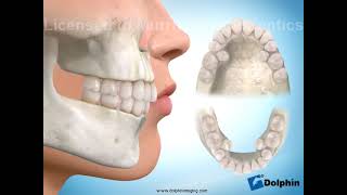 Murrieta Orthodontics Four-bicuspid extraction all 2nd (blocked lingual)