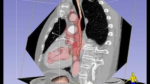 Mid-Esophageal 2-Chamber Imaging Plane in TEE - Standard View