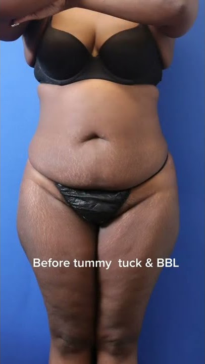 Tummy Tuck with Brazilian Butt Lift by Dr. Erick Sanchez in Baton Rouge, LA