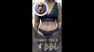 Tummy Tuck With Brazilian Lift By Dr. Erick Sanchez In Baton Rouge, La
