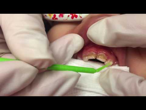 Video: How To Treat Caries In A 2-year-old Child