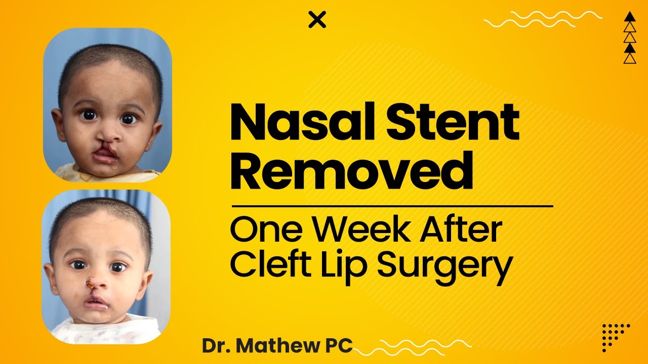 Nasal Stent Removed One Week After Cleft Lip Surgery In India Dr