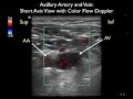 How To: Axillary Vein Cannulation - SonoSite Ultrasound.mp4