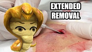 Cobra's EXTENDED Cyst Extraction | Dr. John Gilmore