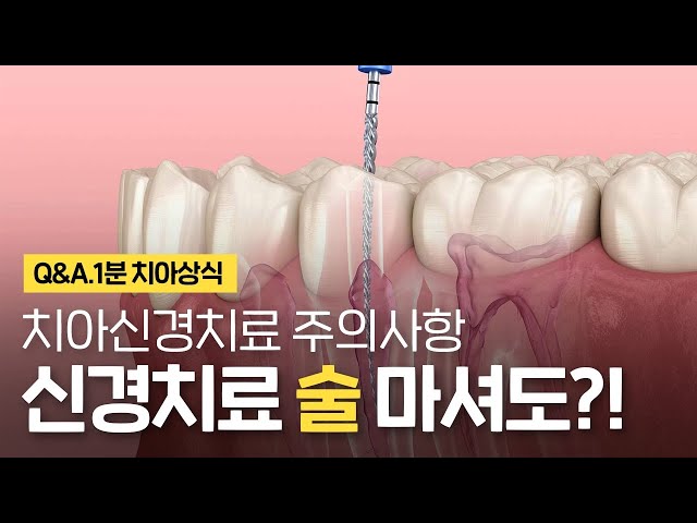 치아 신경치료 술 음주 무조건 안된다? 신경치료 주의사항 ⏰1분 치아상식
