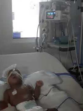 patience in ICU after surgery on cipap 2