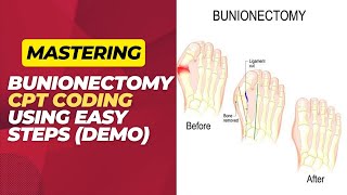 MSTERING BUNIONECTOMY CPT CODING IN EASY STEPS