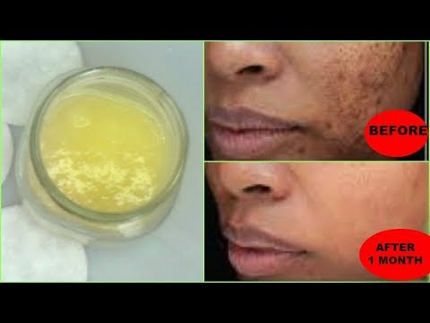 REMOVE DARK SPOTS, BLACK SPOTS, ACNE SCARS NATURALLY AND FAST, GET FLAWLESS SKIN Khichi Beauty