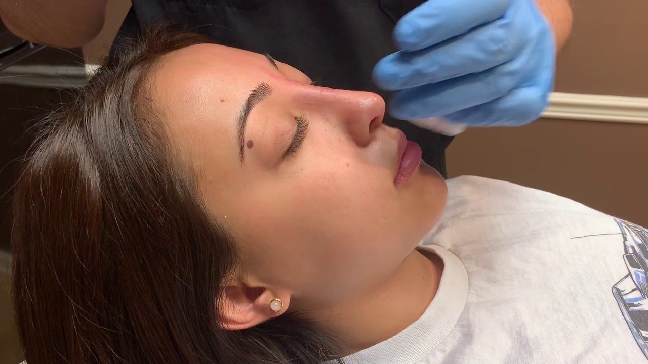 Nonsurgical Rhinoplasty Touch-up with Restylane-L - YouTube