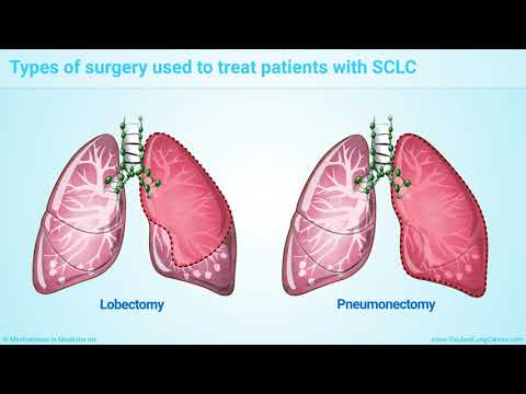 Video: Small Cell Lung Cancer: Description. How To Treat Fine-grained Lung Cancer: Tips