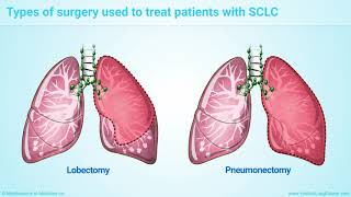 Treatment and Management of Small Cell Lung Cancer (SCLC)