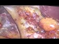 Mini with Reduced Port Laparoscopic Cholecystectomy #bestgallbladdersurgery