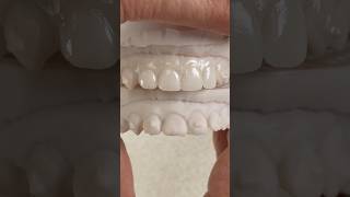 Treatment Plan Wax-Up that we just completed in my laboratory for Dr. Daniel Derosa in Pennsylvania