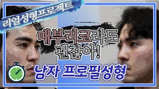브랜드성형외과 낮은 코와 돌출 입을 한 번에 프로필 코성형, 남자코