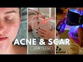 Asmr acne and scar lightening facial treatment  guided meditation  jadeywadey180
