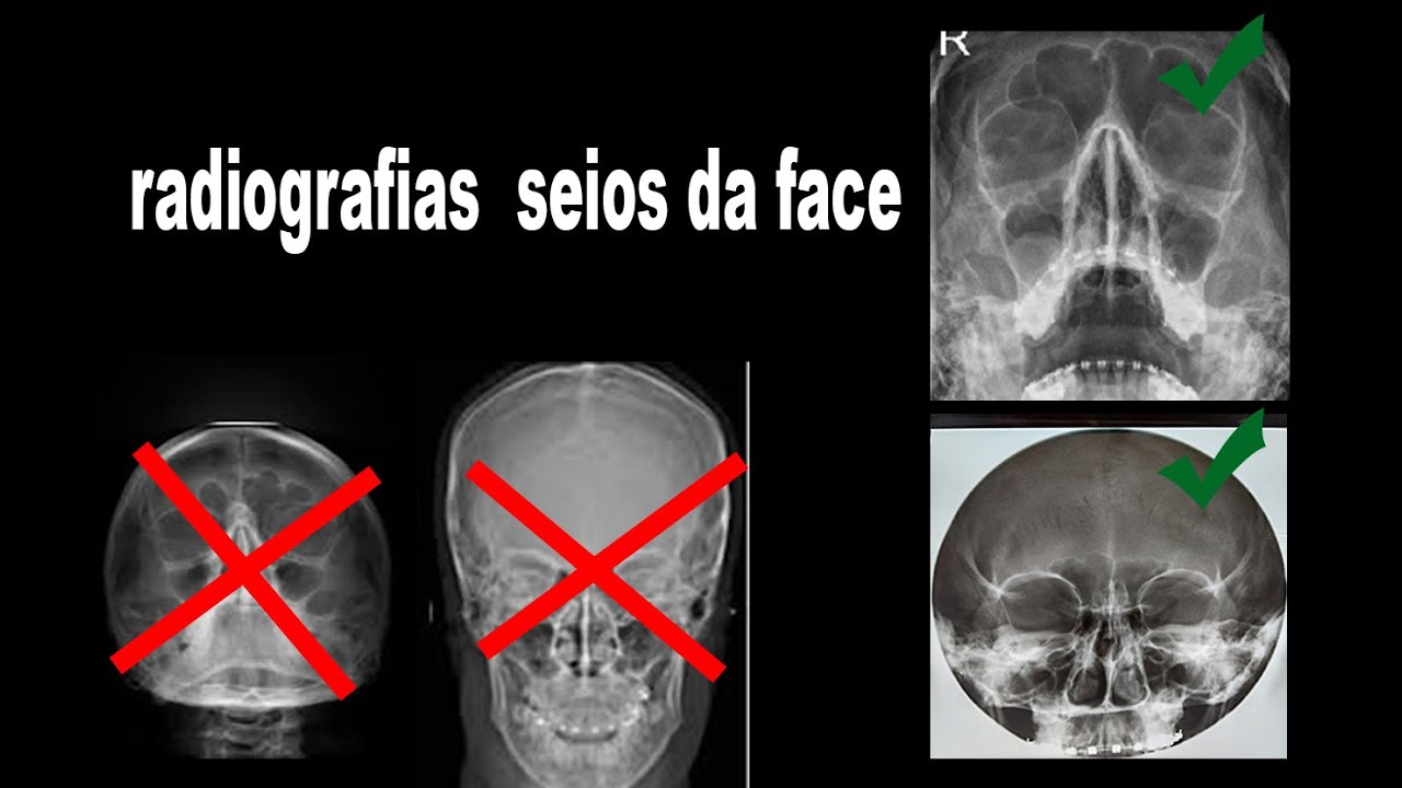 Caldwell e Waters, Radiografias dos Seios da Face ! YouTube Caldwell e Waters, Radiografias dos Seios da Face ! YouTube