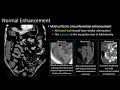 The Normal Small Bowel